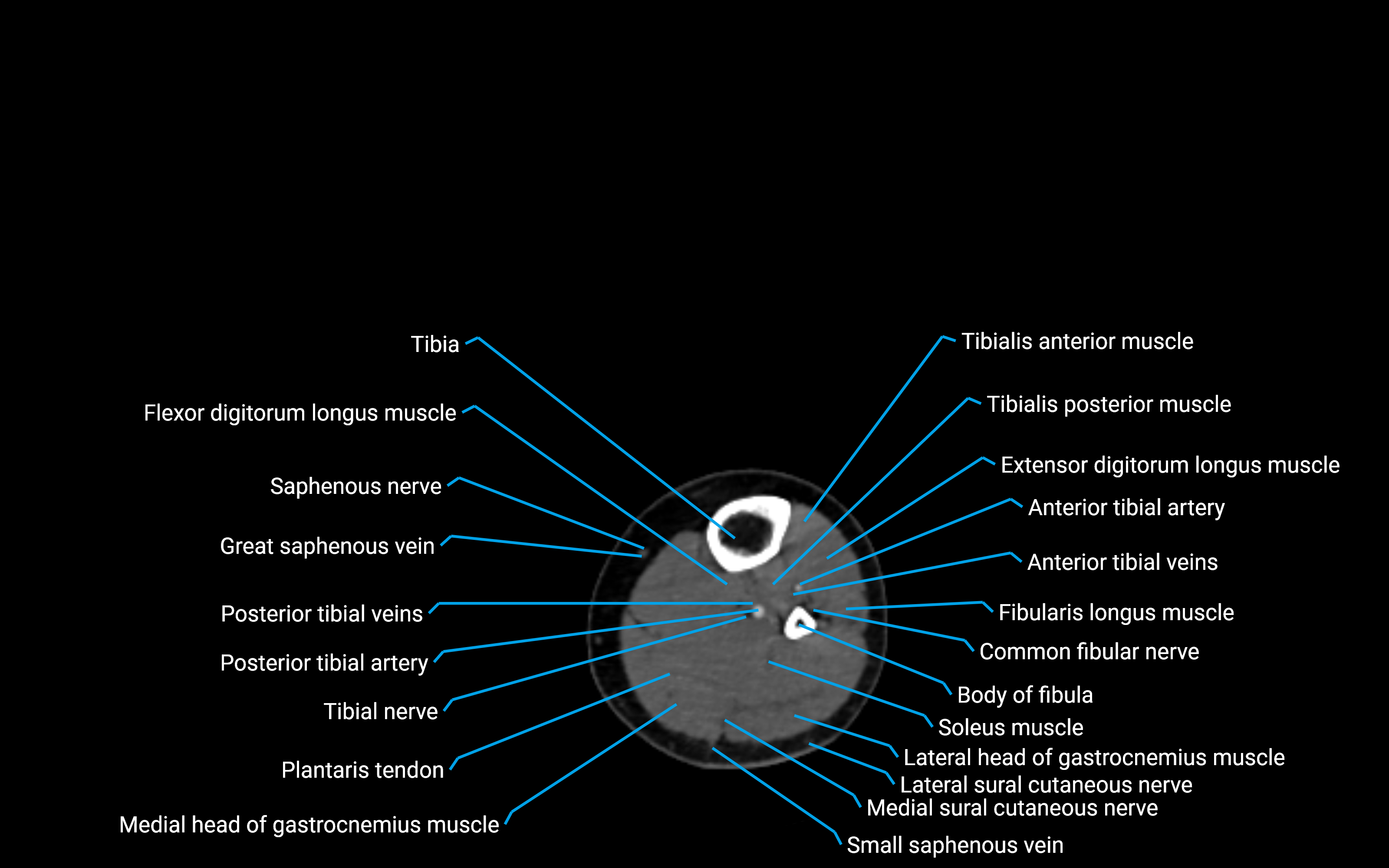 CT Lower leg axial cross sectional anatomy labelled image 106 (2).png